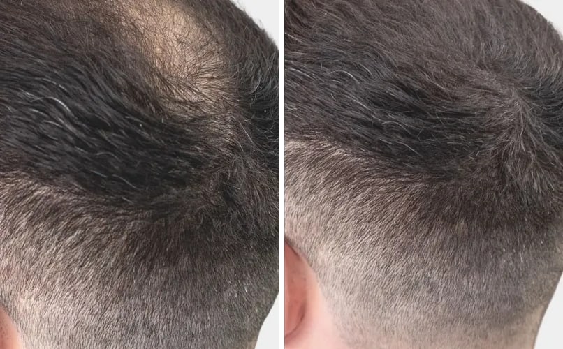 Kruna iz poluprofila, prije i poslije nanošenja keratinskih vlakana