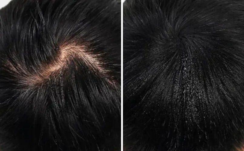 Tjeme odozgo, prije i poslije nanošenja keratinskih vlakana