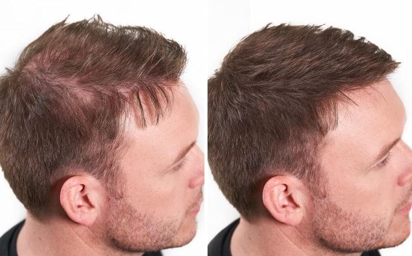 Zalisci iz profila, prije i poslije nanošenja keratinskih vlakana