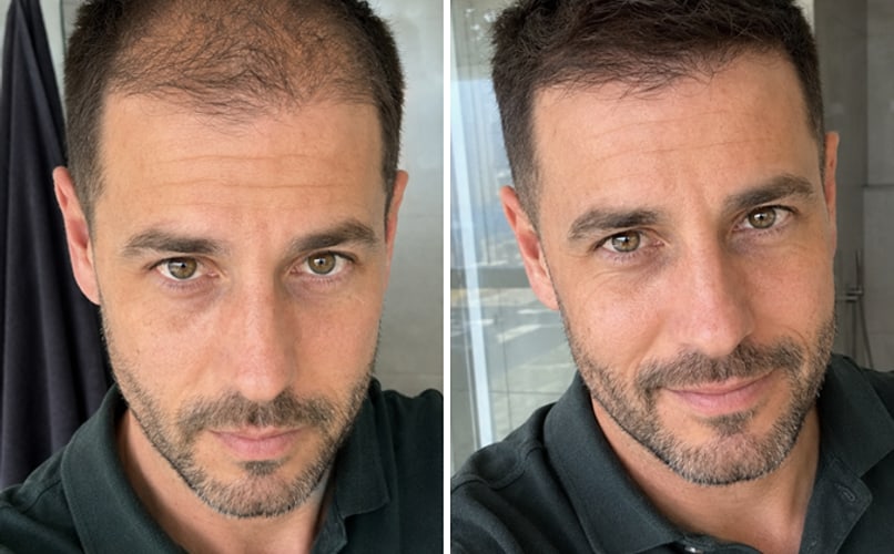 Prednji dio, selfie, prije i poslije nanošenja keratinskih vlakana