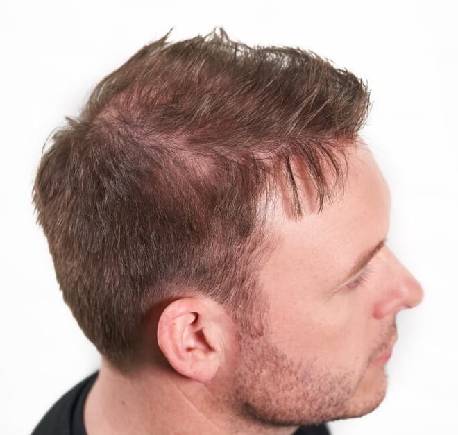Zalisci i linija čela, prije nanošenja keratinskih vlakana